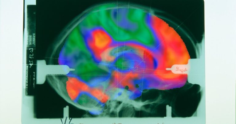 Nizozemští neurovědci zpochybňují novou techniku analýzy duševních nemocí: 'Základní mylná úvaha'