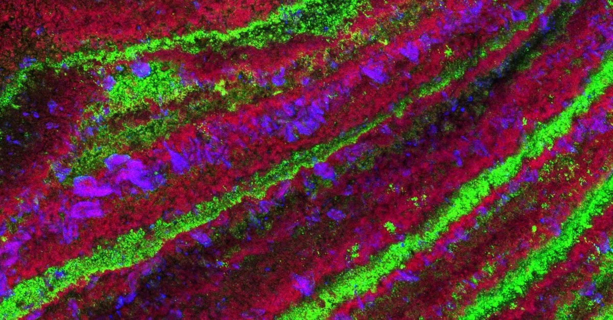 Objev vrstev bakterií v ledvinových kamenech